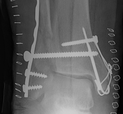 Ankle Fracture Diastasis Screw